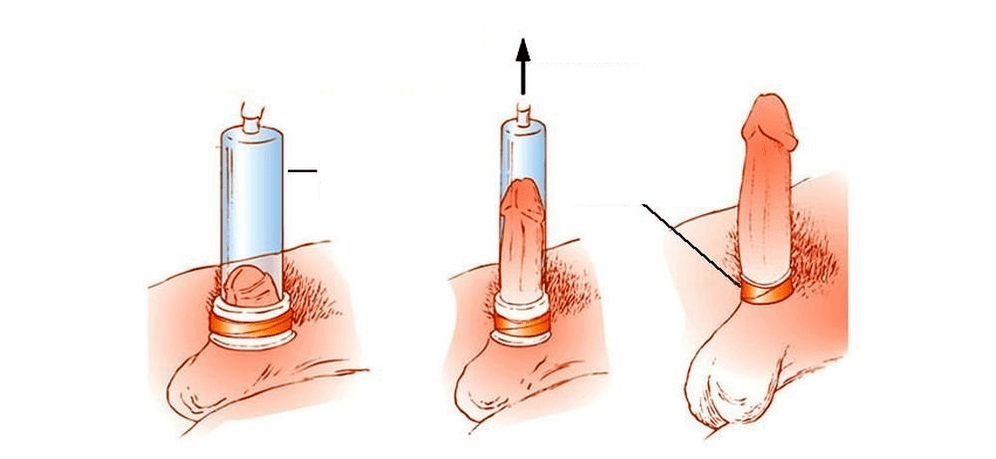 jak funguje vakuová pumpa pro zvětšení penisu