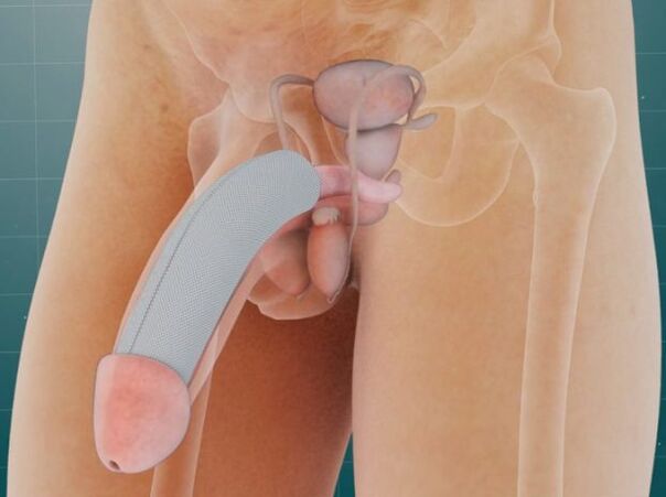 Penis po zavedení speciálního implantátu pod kůži