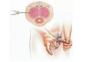 injekční zvětšení penisu
