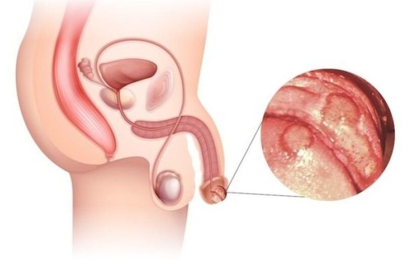 zvětšení malého penisu a žaludu