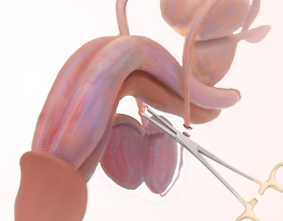ligamentotomie pro zvětšení penisu