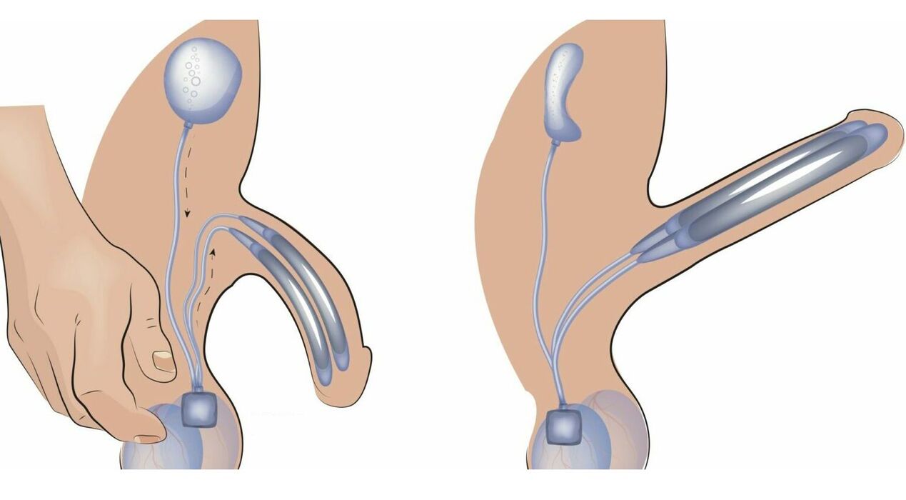 protéza penisu pro zvětšení penisu